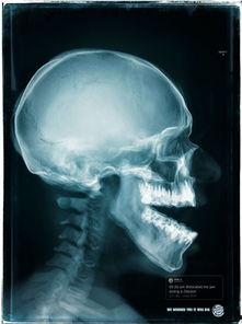 吃瓜下巴脱臼视频真实吗,真相揭秘还是网络恶搞？